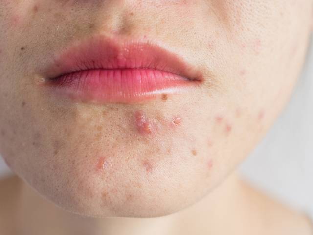 Acne - Don't Suffer in Silence | Girl.com.au